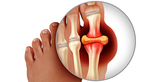 Nhận biết các tác nhân phổ biến gây ra cơn đau bùng phát dữ dội với người bệnh gout - 1