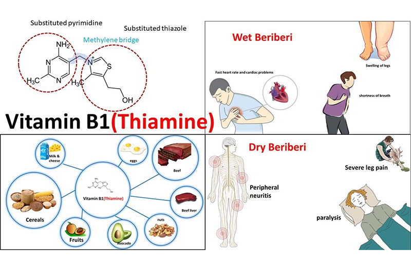 Thiếu hụt vitamin B1 gây ra bệnh lý ảnh hưởng nghiêm trọng đến hệ thần kinh