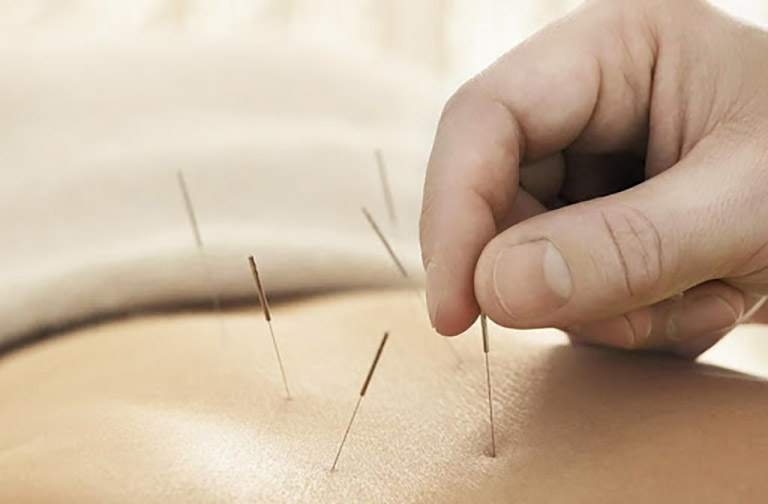 Kết hợp bấm huyệt với phương pháp châm cứu giúp đẩy nhanh tốc độ điều trị bệnh