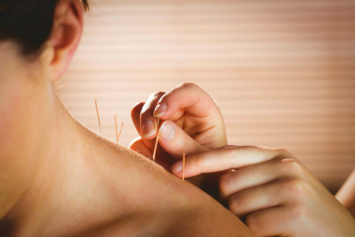 Châm cứu trị mất ngủ
