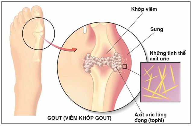 Bị bệnh gút có dùng được đông trùng hạ thảo không?